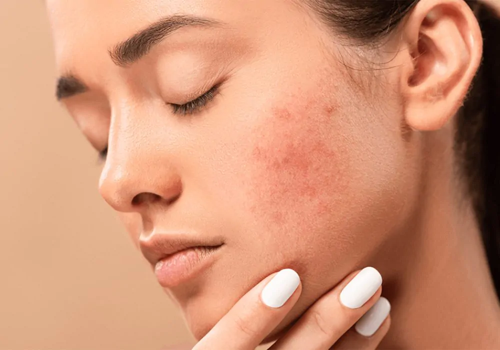 Acne: Causas, Tratamentos e Dicas para uma Pele Saudável