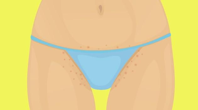 Pelo encravado na virilha: como prevenir?