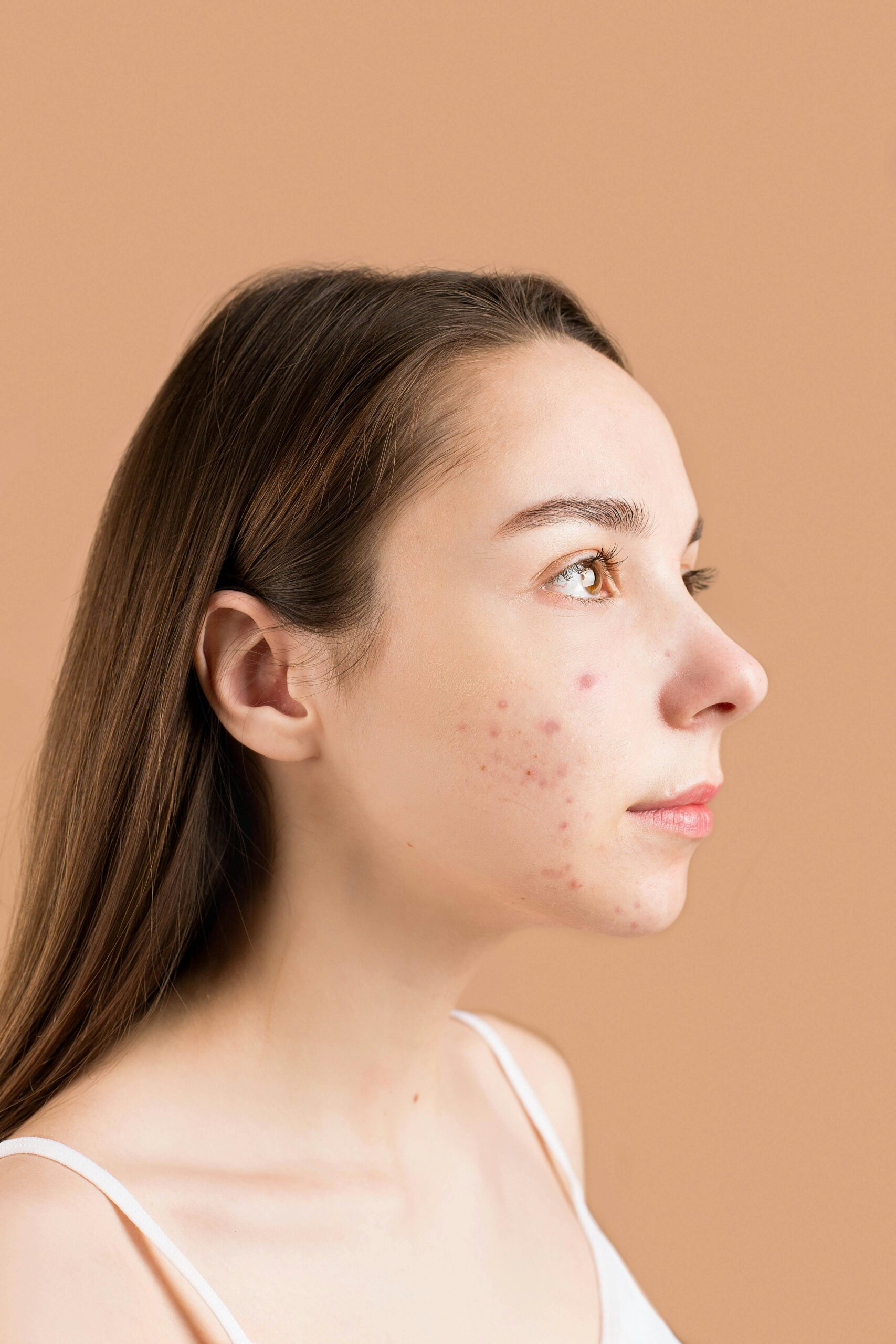 5 Alimentos que Causam Acne para Evitar