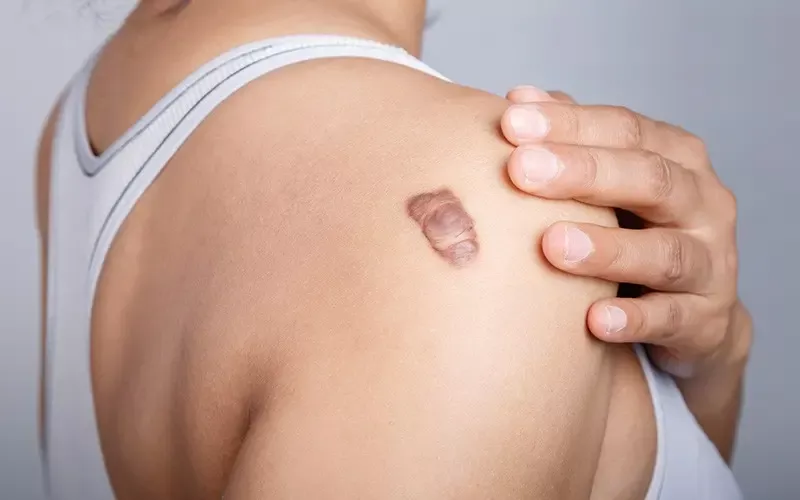 Tratamento de Queloide: Qual o mais indicado?