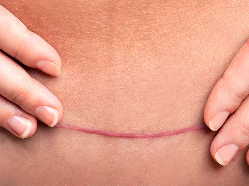 Cicatrizes hipertróficas: O que é?