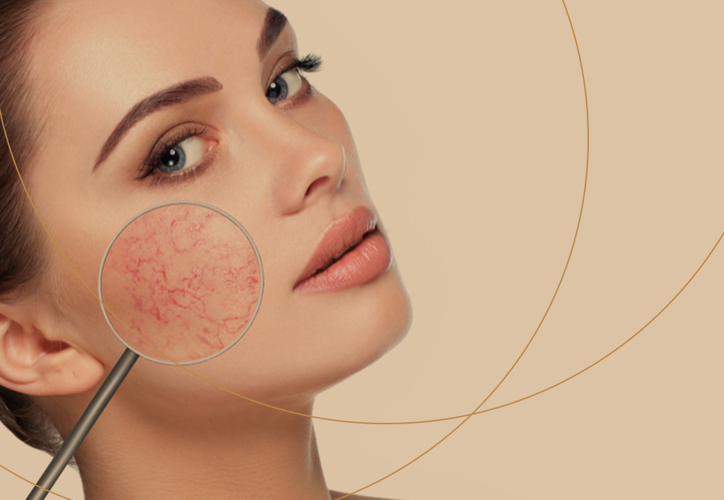 Rosácea: Sintomas, Causas, Tratamentos e Dicas de Cuidados com a Pele