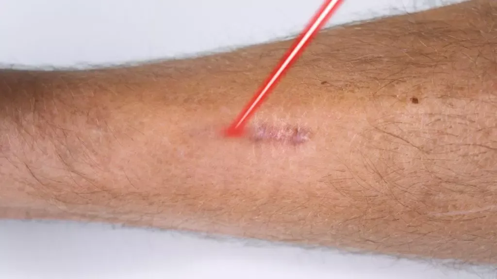 Laser para Cicatriz: Como funciona e quais os benefícios?